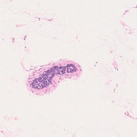 血管内大細胞型B細胞性リンパ腫